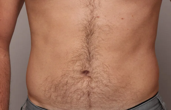 The effect of using ulike air 10 before belly hair removal