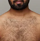 The effect of using ulike air 10 before chest hair removal