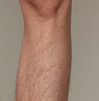 The effect of using ulike air 10 before leg hair removal